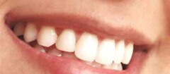 implantes-dentarios-caxias-1394908268